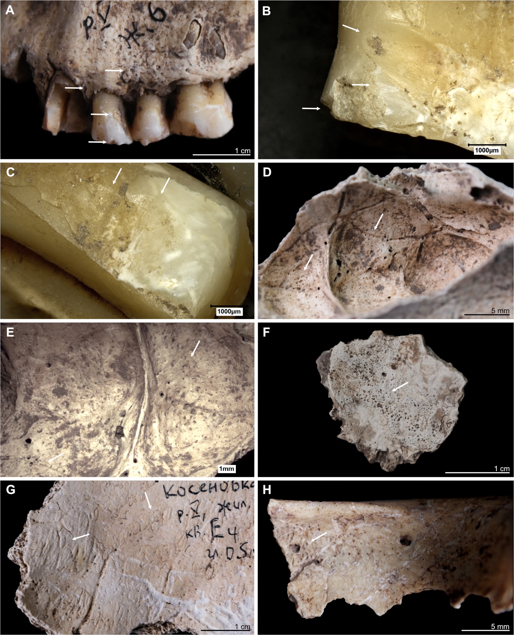 Kosenivka, selection of oral and pathological conditions. A–E: Individual 5/6/+left maxilla. A: Teeth positions 23–26 (buccal view). Signs of periodontal inflammation (upper arrows) and examples of dental calculus accumulation (third arrow) and dental chipping (lower arrow) on the first premolar (tooth 24). B: First premolar (24, mesial view). Interproximal grooving with horizonal striations on the lingual surface of the root (upper arrow) and at the cemento–enamel junction (middle arrow). Larger chipping lesion (lower arrow). C: Canine (23, distal view). Interproximal grooving, same location as on the neighbouring premolar (see B), but less distinct. D, E: Signs of periosteal reaction on the left maxillary sinus (medio–superior view). Increased vessel impressions (D, upper arrow) and porosity, as well as uneven bone surface (D, lower arrow, E), indicating inflammatory processes. F: Individual 2, left temporal, fragment (endocranial view). Periosteal reaction indicated by porous new bone formation (arrow). G: Individual 5, frontal bone (endocranial view). Periosteal reaction indicated by tongue-like new bone formation and increased vessel impressions (arrows). H: Individual 5/6/+, frontal bone, right part, orbital roof (inferior view). Signs of cribra orbitalia (evidenced by porosity, see arrow). Kosenivka, selection of oral and pathological conditions. A–E: Individual 5/6/+left maxilla. A: Teeth positions 23–26 (buccal view). Signs of periodontal inflammation (upper arrows) and examples of dental calculus accumulation (third arrow) and dental chipping (lower arrow) on the first premolar (tooth 24). B: First premolar (24, mesial view). Interproximal grooving with horizonal striations on the lingual surface of the root (upper arrow) and at the cemento–enamel junction (middle arrow). Larger chipping lesion (lower arrow). C: Canine (23, distal view). Interproximal grooving, same location as on the neighbouring premolar (see B), but less distinct. D, E: Signs of periosteal reaction on the left maxillary sinus (medio–superior view). Increased vessel impressions (D, upper arrow) and porosity, as well as uneven bone surface (D, lower arrow, E), indicating inflammatory processes. F: Individual 2, left temporal, fragment (endocranial view). Periosteal reaction indicated by porous new bone formation (arrow). G: Individual 5, frontal bone (endocranial view). Periosteal reaction indicated by tongue-like new bone formation and increased vessel impressions (arrows). H: Individual 5/6/+, frontal bone, right part, orbital roof (inferior view). Signs of cribra orbitalia (evidenced by porosity, see arrow).