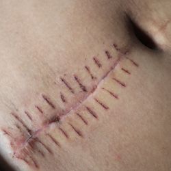 Image of a stomach with a scar on it c-section 