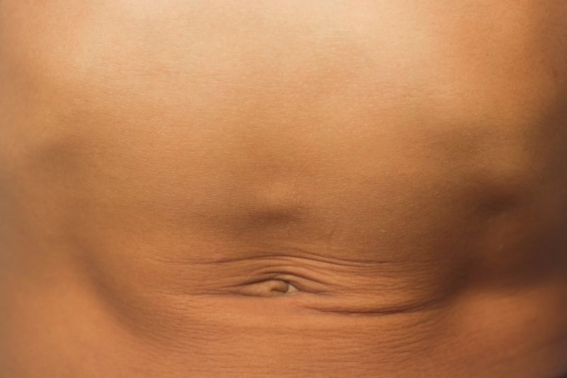 Image of an abdomen with a small bump above the belly button.