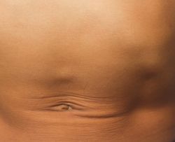 Image of an abdomen with a small bump above the belly button.