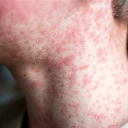 A close up photo of a boy's throat showing the measles rash covering most of his neck and lower face. The photo is limited to just this portion of his body, but it shows just how extensive the rash is. 