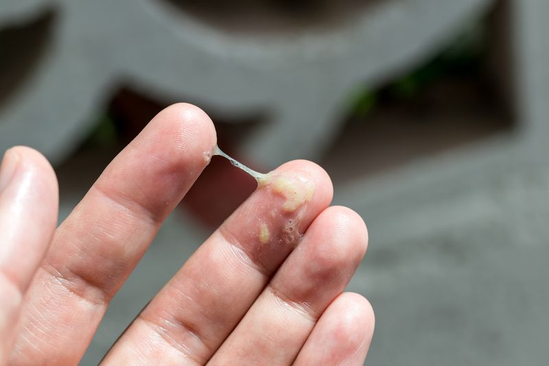 A sick man have a snot on hand. A cold man has snot running on his hand. Mucus on hand.