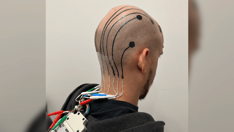 person's head with very short hair, viewed from the back with black e-tattoo electrodes and wires, linked to actual wires that are connected to a device hanging down the person's back.