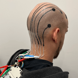 person's head with very short hair, viewed from the back with black e-tattoo electrodes and wires, linked to actual wires that are connected to a device hanging down the person's back.